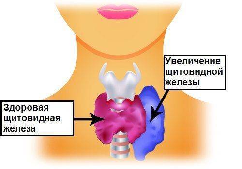 Щитовидная железа картина